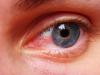 Photo for Global Anterior Uveitis Market Research Report 2016