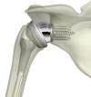 Photo for Global Shoulder Replacement Devices Market 2016 Product Types,Sales,Price,Share and Growth 2021