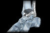 Photo for Global Foot & Ankle Replacement Devices Market 2016 Product Types,Sales,Price,Share and Growth 2021