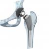 Photo for Global Hip Replacement Devices Market 2016 Product Types,Sales,Price,Share and Growth 2021
