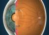 Photo for Global Accommodating Lens Market Research Report 2016
