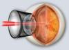 Photo for Global Photocoagulation Laser Market Research Report 2016