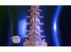 Photo for Global Spinal Cord Stimulator Sales  Industry Research Report 2016