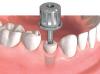 Photo for Global Healing Abutment  Market 2016 Growth, Demand, Revenue, Region, Analysis 2021