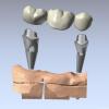 Photo for United States, EU, Japan, China, India and Southeast Asia Dental Software for Dental Prosthesis Design Market Size, Status and Forecast 2021