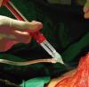 Photo for Fibrin Glue Market: Global Analysis, competitive landscape, key players, Segment & Forecast, 2014 – 2020