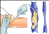 Photo for Global Varicose Vein Treatment Market 2016 Production, Price, Revenue, Cost, Gross Margin and Analysis by 2022