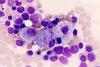 Photo for Global Gaucher Disease Market 2016 - Sanofi, Shire, Actelion Pharma, Pfizer