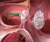 Photo for Global Heart Defect Closure Devices Market 2016 - Occlutech, Starway, Boston Scientific Corp, LifeTech