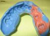 Photo for Global Dental Implants and Prosthetics Market Strategies and Forecast Till, 2016: Reseach Beam