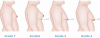 Photo for Man Boobs Surgery