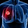 Photo for Global Lung Cancer Therapeutics Market Size, Share, Analysis, Industry Growth and Forecast Research Report 2016-2020 Market Reports Center