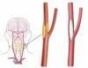 Photo for Global Carotid Stent Market 2016 Industry Growth, Price, Revenue and market share and Analysis by 2021