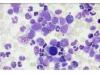 Photo for United States Myeloproliferative Disorders Clinical Trials Market Report 2016