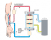 Photo for Global Hemodialysis Concentrate Market 2016 Industry Growth, Trends, Size, Demand, Share and Analysis by 2021
