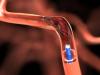 Photo for Global Neurovascular Stent Retrievers Market 2016 Industry Growth, Trends, Size, Demand, Share and Analysis by 2021