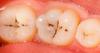 Photo for Global Dental Caries Market 2016 Industry Growth, Trends, Size, Demand, Share and Analysis by 2021