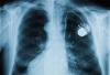 Photo for Cardiac Pacemaker Market : Projection  On New Trends And Technical Advancement For 2023