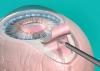 Photo for Global Glaucoma Surgery Devices Market 2016 Industry Growth, Trends, Size, Demand, Share and Analysis by 2021