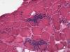 Photo for Tropical Spastic Paraparesis Market  Projection  On New Trends And Technical Advancement For 2024