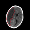 Photo for Cerebral Infarction (Brain Infarction) Market : Overview, Segmentation, Trends and Outlook & Industry Analysis By 2024