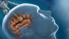 Photo for North America to lead Ablation Technology Market by 2016–2024