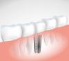 Photo for Dental implants- Latest replacement option for missing teeth