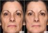 Photo for Rejuvonus Reviews- Reduces Wrinkles & Tightens Your Skin!