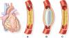 Photo for Global Angioplasty Balloons Market Research Report 2016