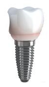 Photo for Dental Implants Market to surpass US$ 537.3 MILLION by 2024 : Coherent Market Insights