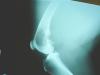 Photo for Bone Cancer Treatment Market - Global Industry Insights, Trends and Opportunity Analysis, 2016–2024