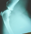 Photo for Bone Degeneration Therapeutics Market - Global Industry Insights, Trends and Opportunity Analysis, 2016–2024