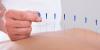 Photo for Acupuncture Advantage over Modern Day Medicine