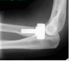 Photo for Radial Head Resection Implants Market Forecasts up to 2024, Research Reports- Coherent Market Insights