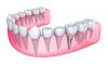 Photo for Dental Implants in Ahmedabad