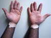 Photo for Leprosy Treatment Market and Opportunity Analysis, 2016–2024
