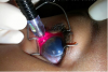 Photo for Refractory Glaucoma Treatment Market Forecasts up to 2024, Research Report - Coherent Market Insights