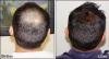 Photo for Latisse Hair Growth