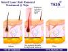 Photo for Safe Laser Hair Removal Treatment at Teja's