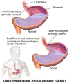 Photo for Gastroesophageal Reflux Disease Treatment Devices Market - Size, Share, Growth, Trends and Forecast to 2024