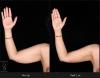 Photo for How Arm Liposuction Improves Upper Arm Contour