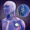 Photo for China Vagus Nerve Stimulation Devices Market Research Report 2017