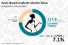 Photo for Asian Breast Implants Market Projected to Reach US$ 287.0 Million by 2025 End