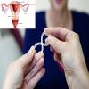 Photo for United States Postmenopausal Vaginal Atrophy Treatment Market Trends & Forecast 2022