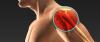 Photo for Global Extremity Reconstruction Sales Market Report 2017