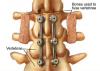Photo for Europe Spinal Fusion Market Report 2017