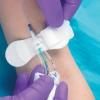 Photo for 2017 Top 5 Catheter Stabilization Device Manufacturers in North America, Europe, Asia-Pacific, South America, Middle East and Africa