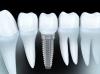 Photo for Global Dental Fitting Market by Manufacturers, Countries, Type and Application, Forecast to 2022