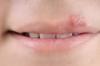 Photo for Ultimate Cure For Herpes