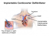Photo for Implantable Defibrillators Market to Reach $8,449 Million, Globally, by 2022